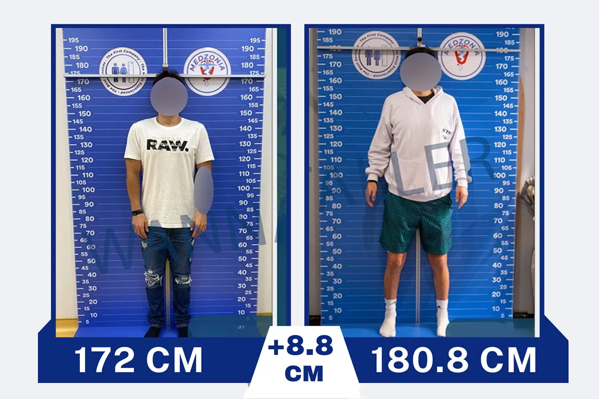 Before After 10