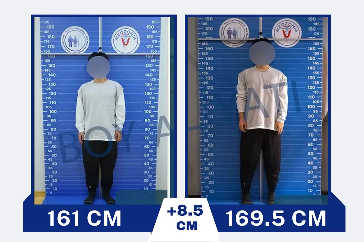 Before After 13