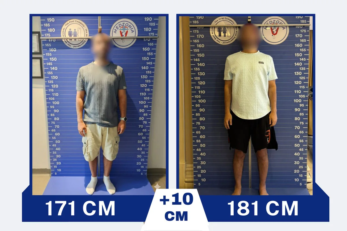 Before After 14