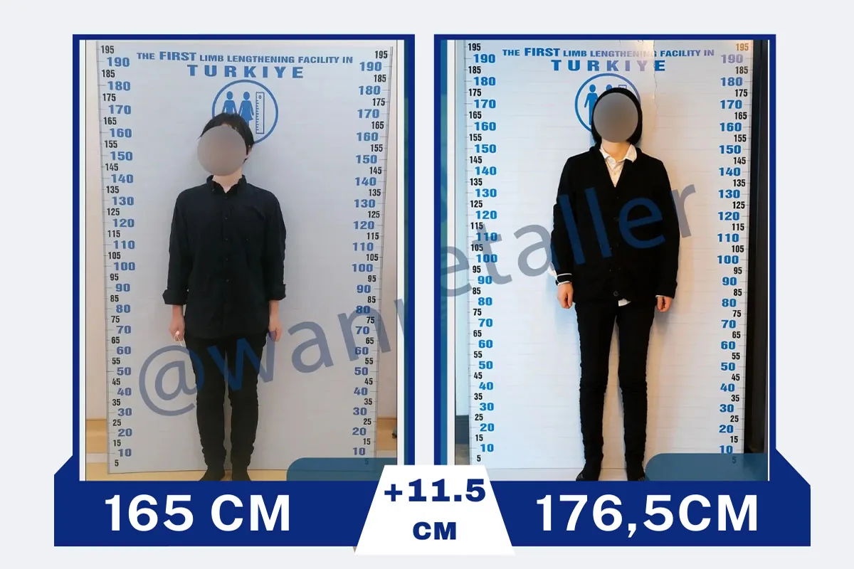 Before After 18