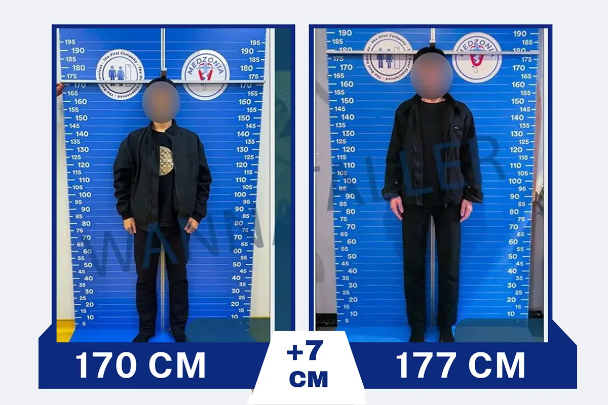 Before After 23