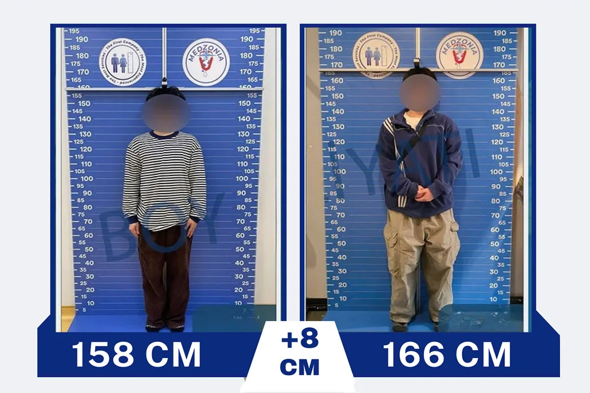 Before After 26