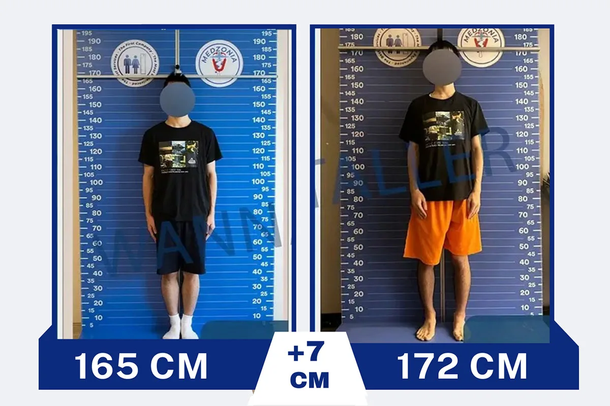 Before After 27