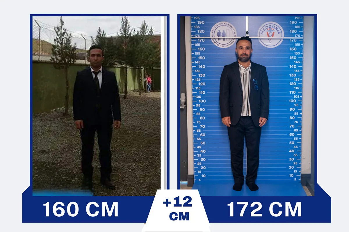 Before After 5