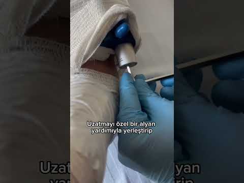 Alt Bacaktan LON Yöntemiyle Uzatma Nasıl Yapılır? (Kombine/Lon Yöntemi)
