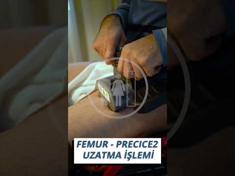 Precice 2.2 Yönteminde Uzatma İşlemi