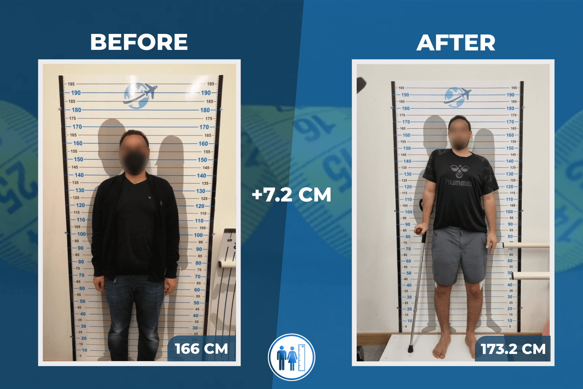limb-lengthening-surgery-before-after-1