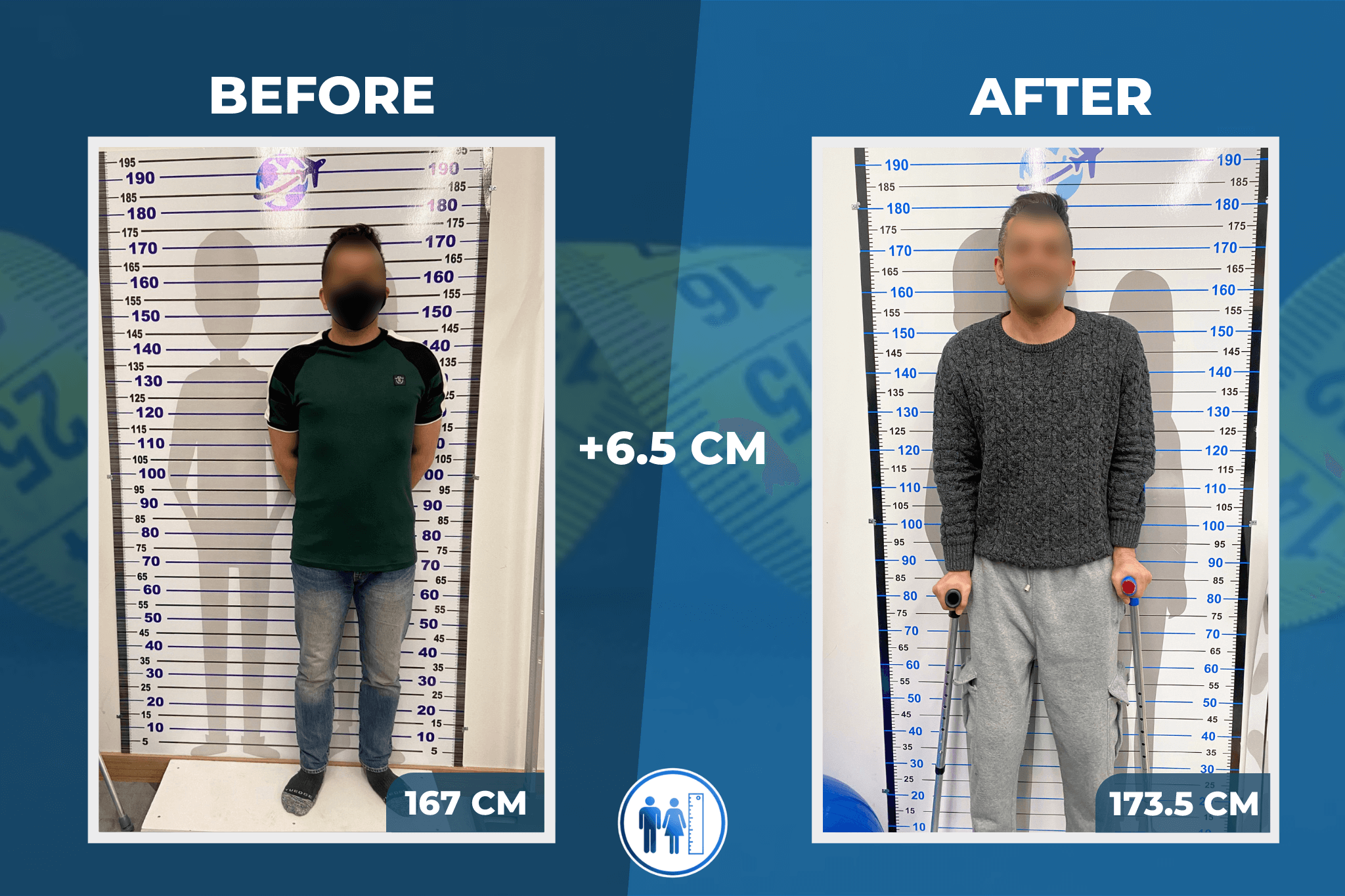 limb-lengthening-surgery-before-after-3