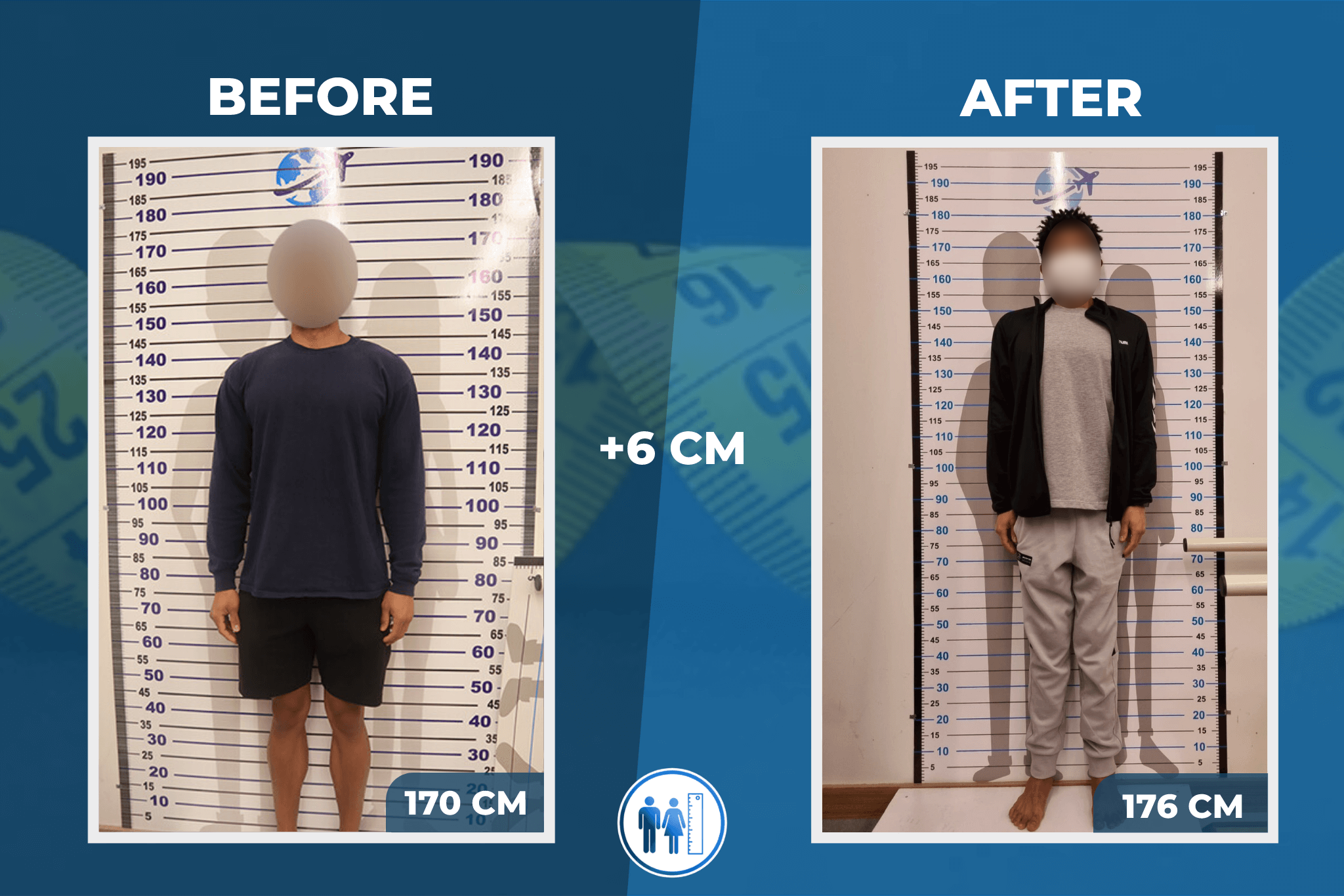 limb-lengthening-surgery-before-after-4