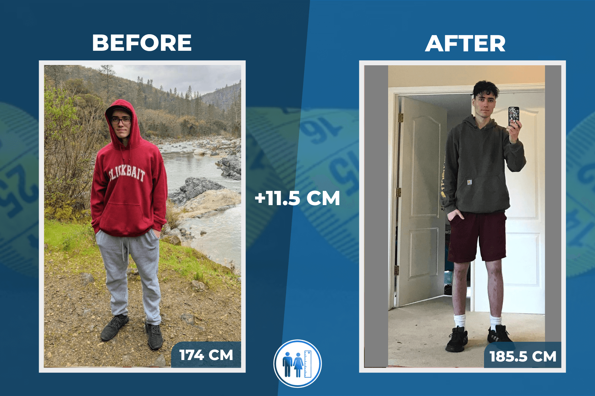 limb-lengthening-surgery-before-after-5