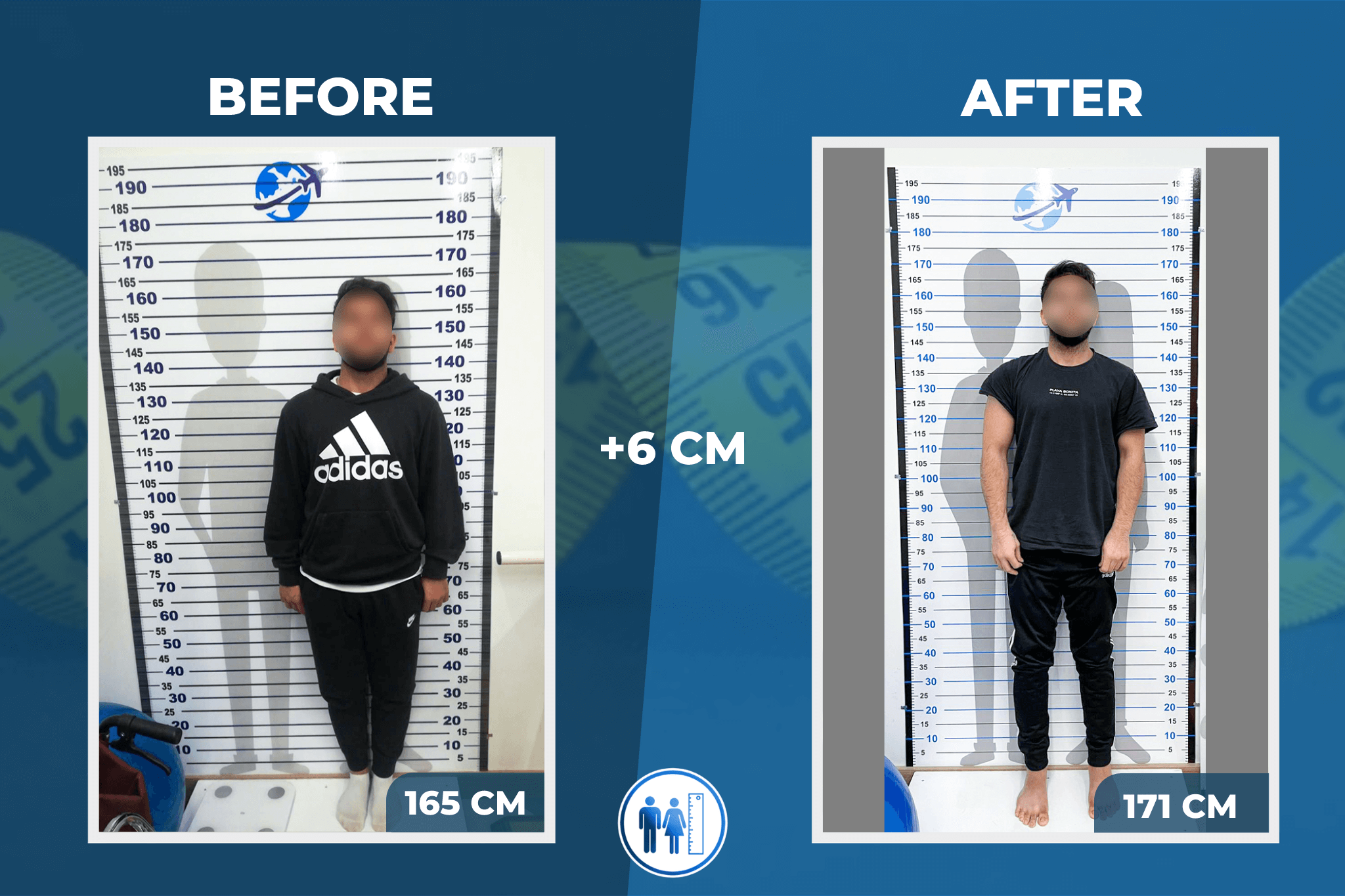 limb-lengthening-surgery-before-after-6