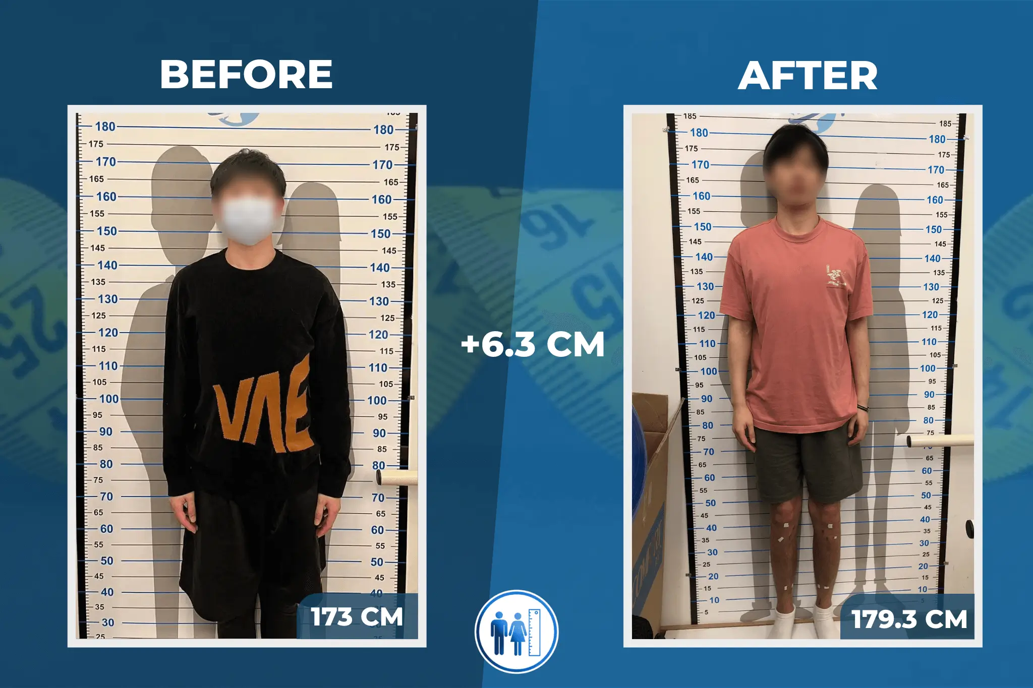 limb-lengthening-surgery-before-after-8