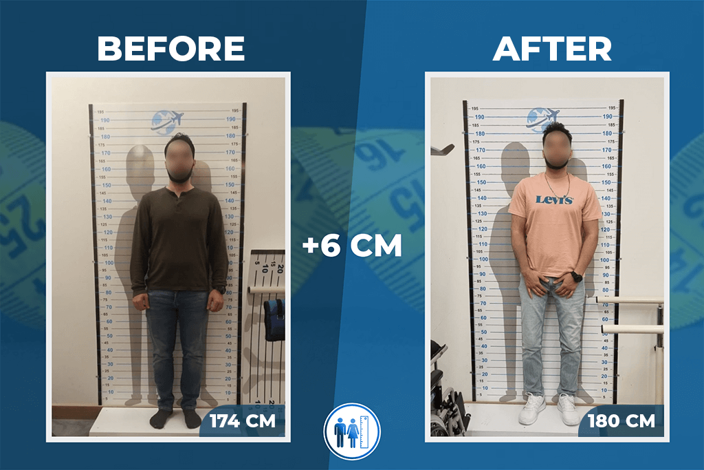 limb-lengthening-surgery-before-after